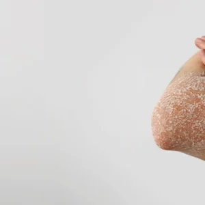 Online Prescription for Psoriasis Treatment - Fast and Effective