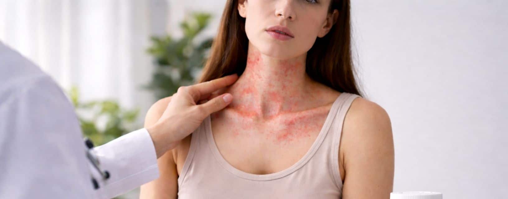 Mulher com reação cutânea no pescoço durante avaliação médica de alergia a medicamentos