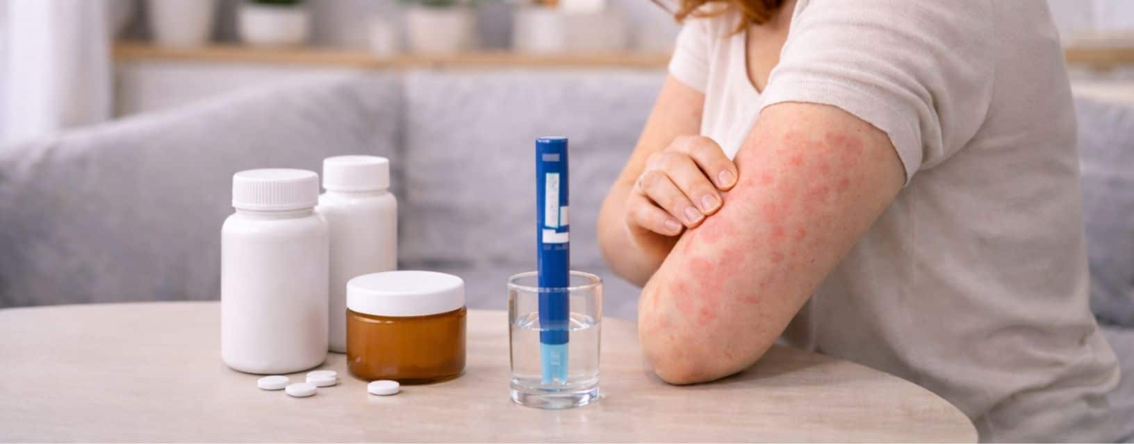 Mulher com urticária no braço apresentando irritação cutânea e desconforto